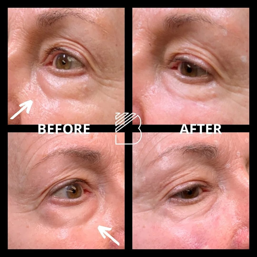 Before and After Image: Case 17 - front