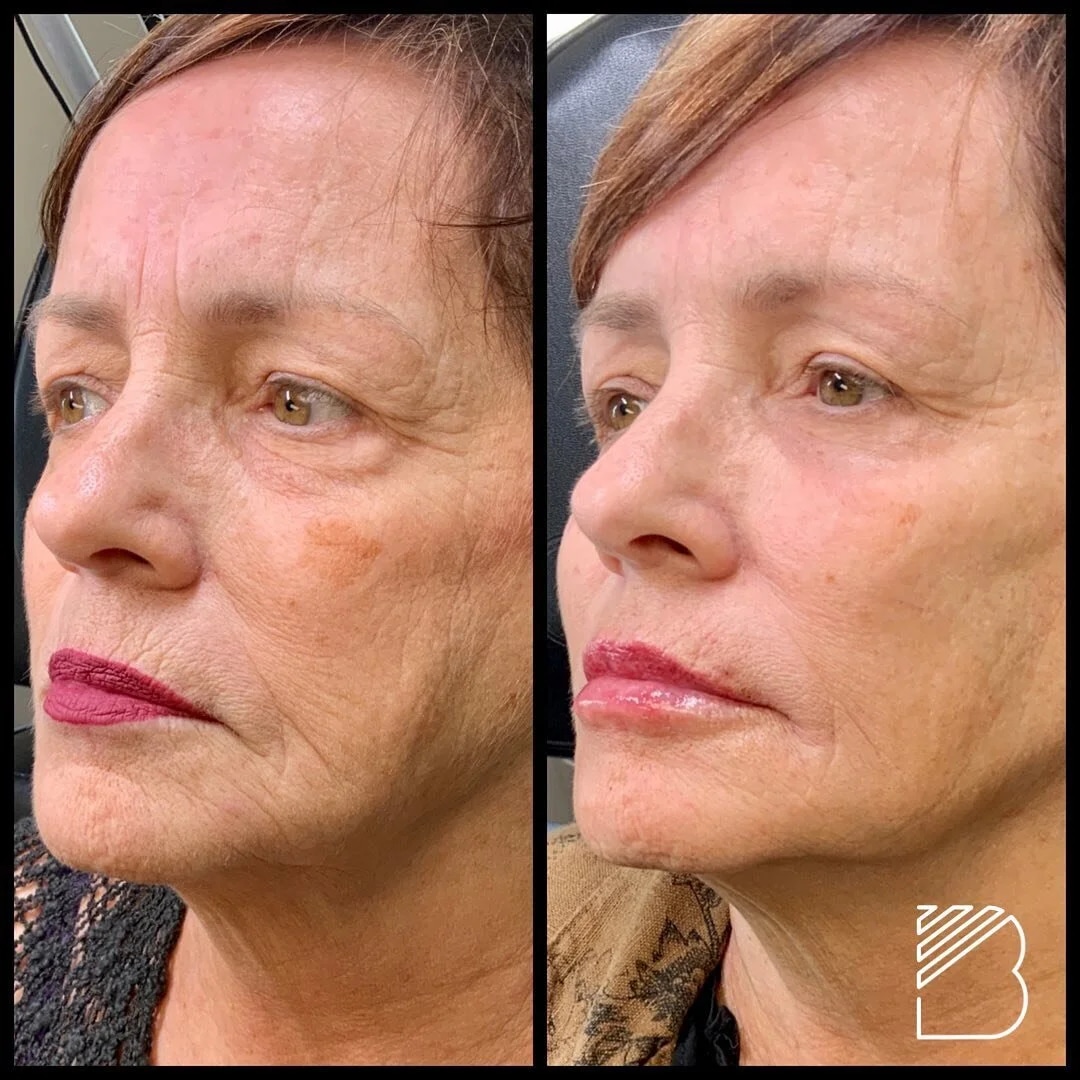 Before and After Image: Case 5 - front